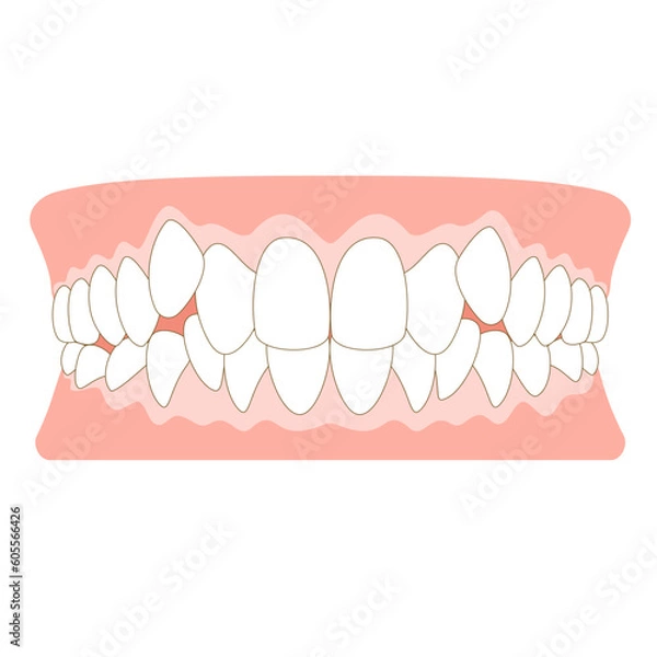 Obraz 八重歯の歯並び