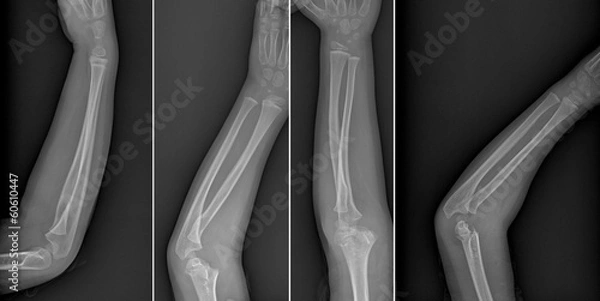Obraz Broken arm xray