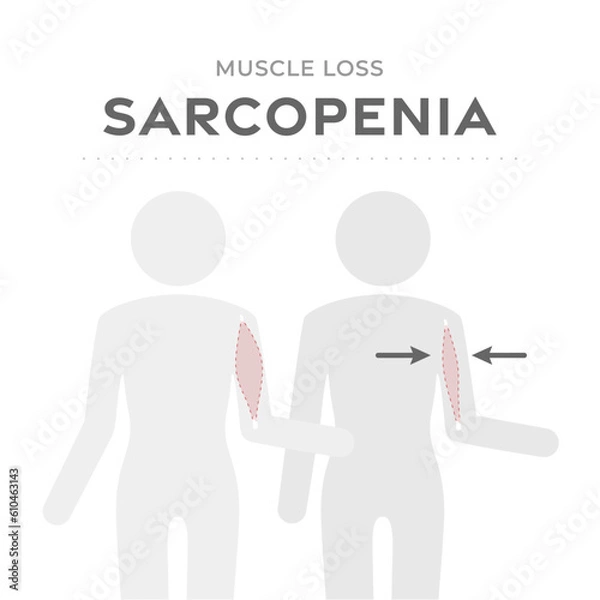 Obraz Sarcopenia, muscle loss medical scheme. Vector illustration with human body pictogram comparing normal Healthy muscle mass and weak old muscle atrophied in the aging process.  Medical infographic