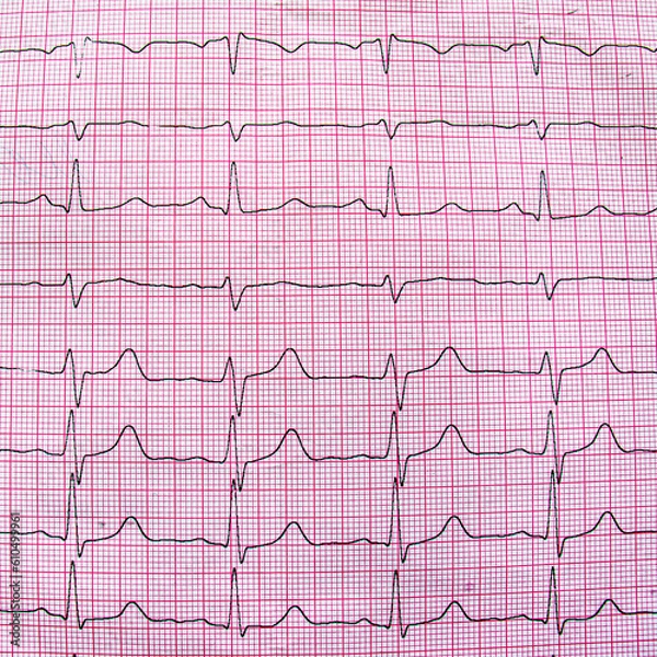 Fototapeta Electrocardiogram example of a normal 12-lead sinus rhythm, close up