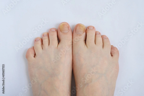 Obraz Toenails affected by fungal infection. Onychomycosis