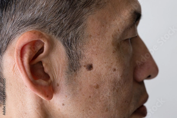 Fototapeta 中年男性の顔のシミのクローズアップ