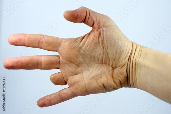Obraz Amputated finger