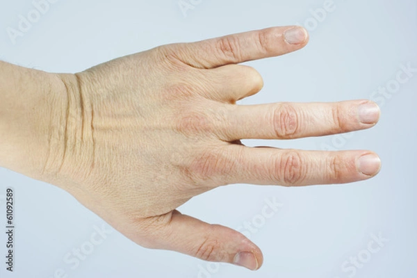 Obraz Amputated finger