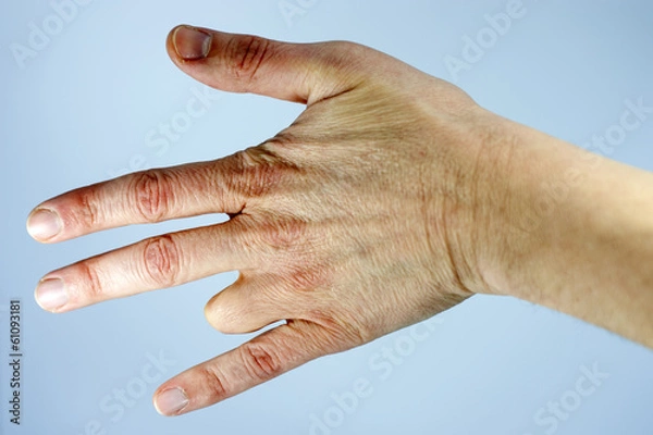 Obraz Amputated finger
