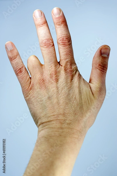 Obraz Amputated finger