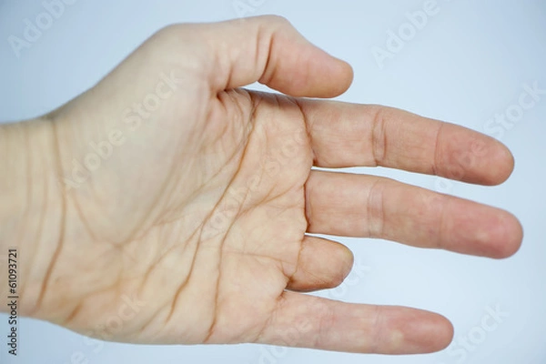 Fototapeta Amputated finger