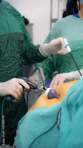 Obraz Obesity surgery. Weight loss surgery with laparoscopy technique.