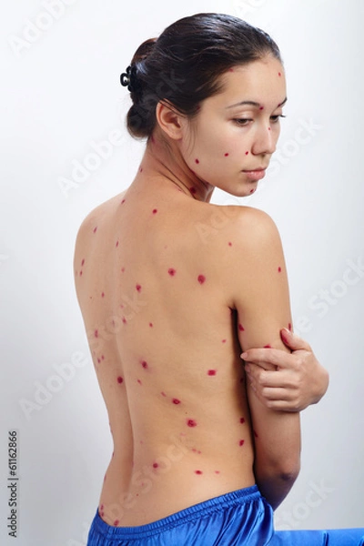Obraz chicken-pox girl