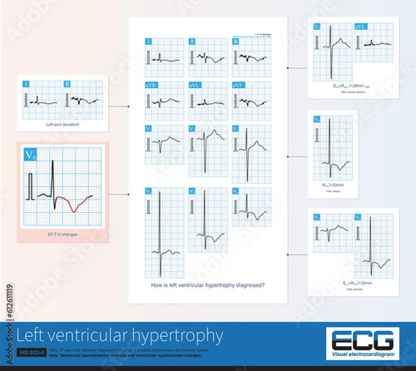 Fototapeta Common ECG changes in left ventricular hypertrophy include increased amplitude of QRS waves, ST-T changes, U-wave changes, left axis deviation, and left atrial abnormality.