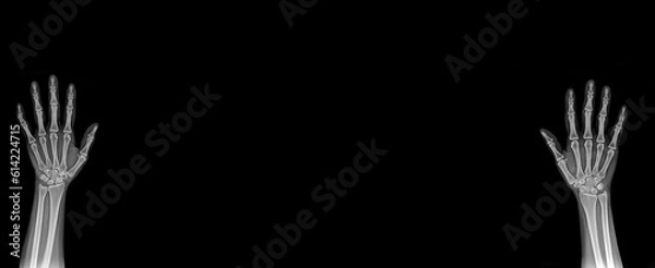 Obraz X-Ray Hands ( front view ) : Normal human hands