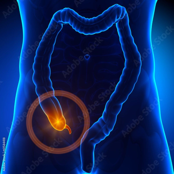 Obraz Appendix pain