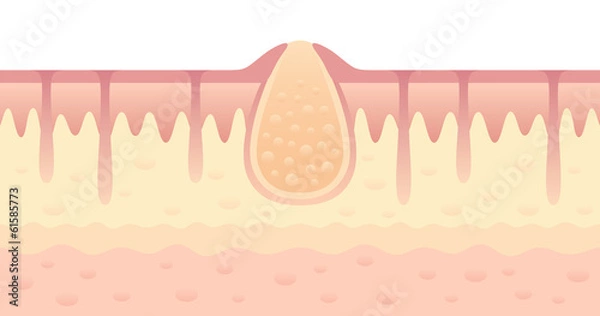 Obraz Pimple on skin