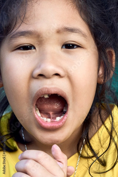 Fototapeta Broken milk teeth