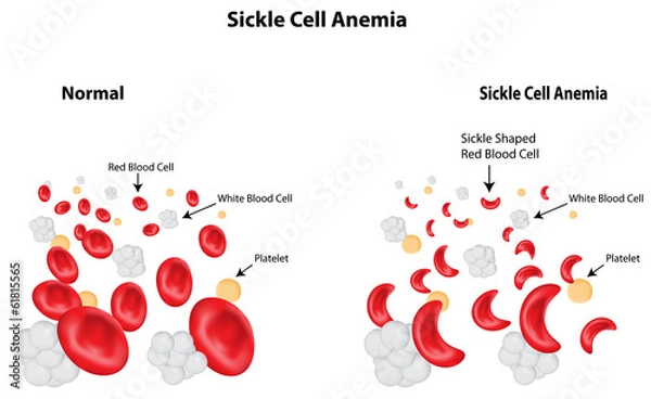 Obraz Sickle Cell Anemia