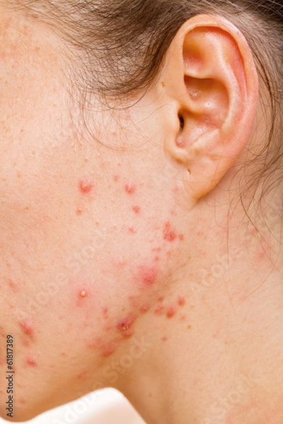Obraz Acne skin