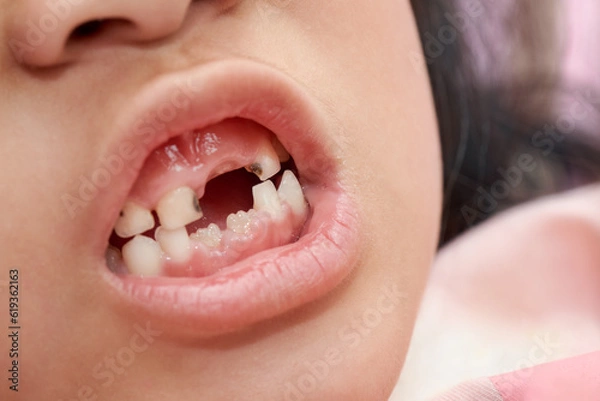 Fototapeta Broken milk teeth