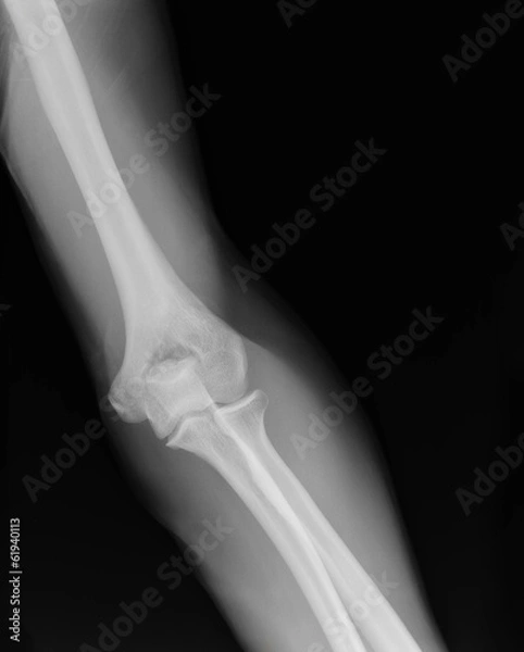 Obraz arm  xray