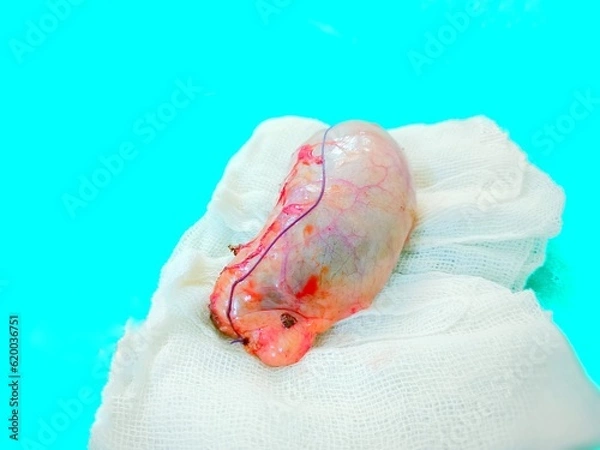 Fototapeta Acute cholecystitis S/P Cholecystectomy, Gallbladder