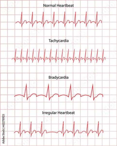 Fototapeta ECG Pathology DIsease