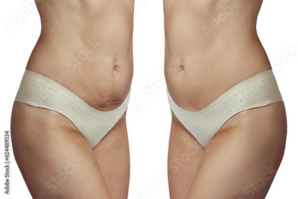 Fototapeta abdominoplasty before and after. Correction of sagging skin. Isolated on white background.