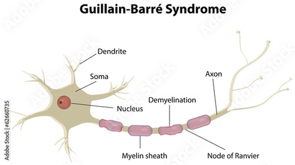Fototapeta Guillain-Barré Syndrome