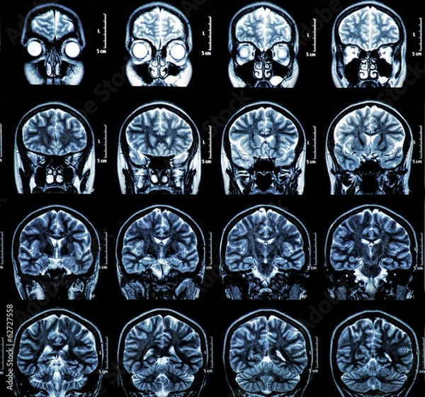 Fototapeta MRI Brain Scan