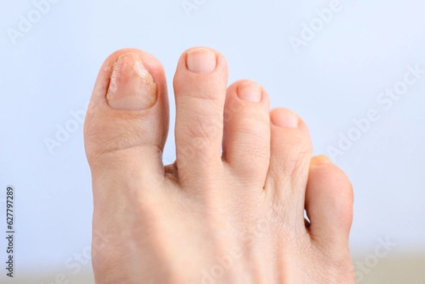 Obraz Onychomycosis. Appearance of toenails affected by fungal infection