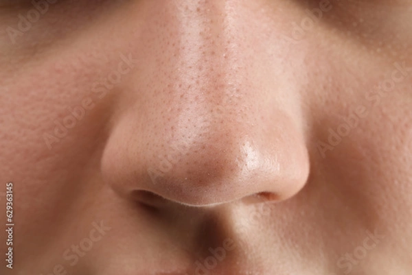 Fototapeta Young woman with acne problem, closeup view