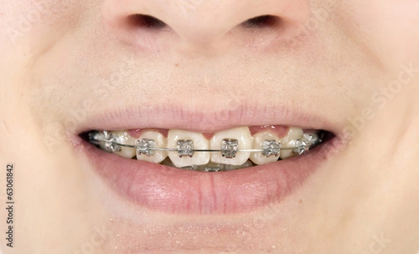 Fototapeta Orthodontics braces