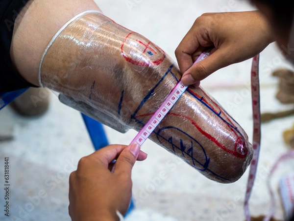 Fototapeta Medical personnel measuring amputated leg to make a prosthetic leg..