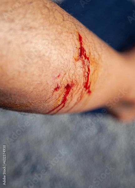 Obraz Dog bites leg  bleeding wound