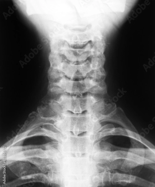 Fototapeta X-ray image of cervical vertebrae