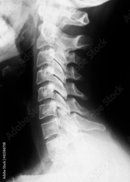 Obraz X-ray image of spinal column.side view