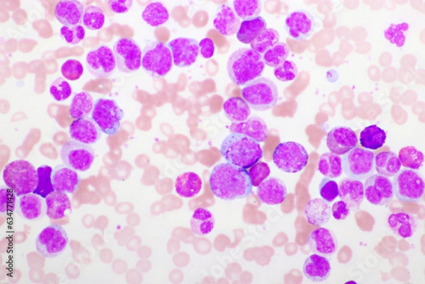 Fototapeta Chronic myeloid leukemia cells or CML, analyze by microscope