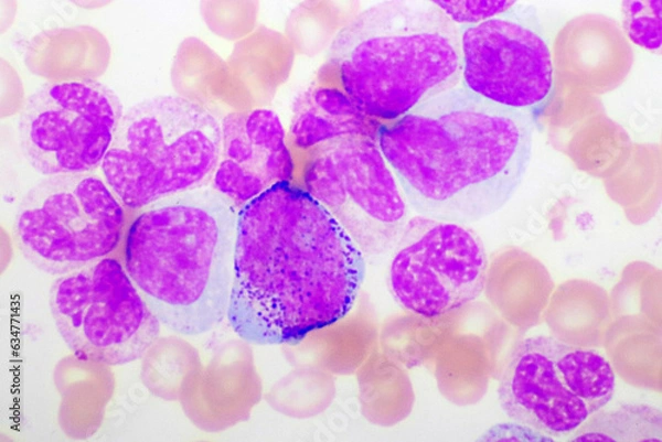 Fototapeta Chronic myeloid leukemia cells or CML, analyze by microscope