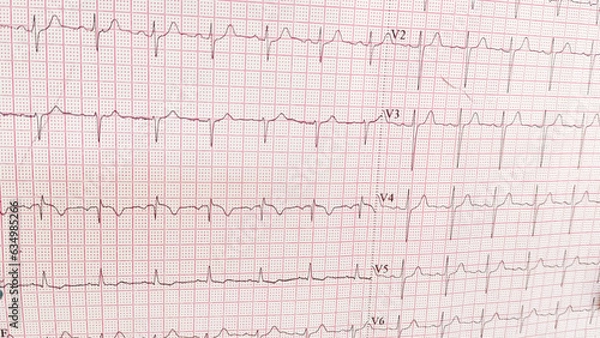 Fototapeta ECG pulse rate paper that shows sinus rhythm abnormality of right ventricular hypertrophy. Cardiac fibrillation. Normal sinus rhythm ECG. Vital sign. Medical healthcare symbol.