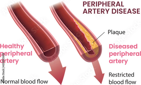 Fototapeta illustration of peripheral artery disease infographic vector