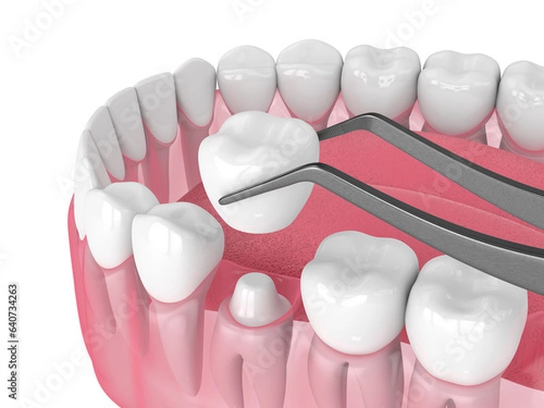 Fototapeta 3d render of crown replacement on reshaped tooth