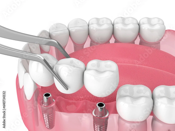 Fototapeta Jaw with implants supporting dental bridge over white