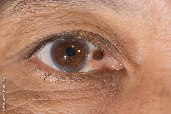 Obraz pterygium