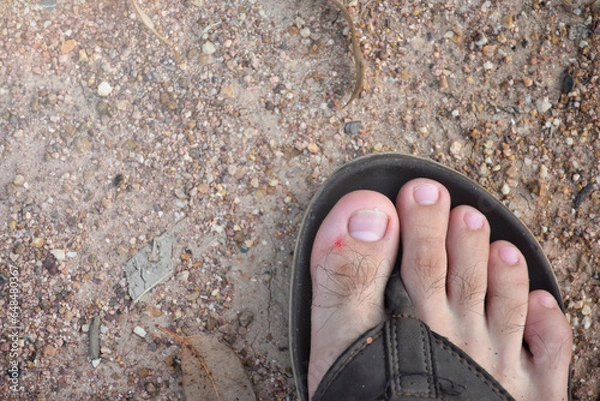 Obraz Wounds on the feet close up on earthy background with soft sunlight, feet in sandals,scar on foot,dermatitis.