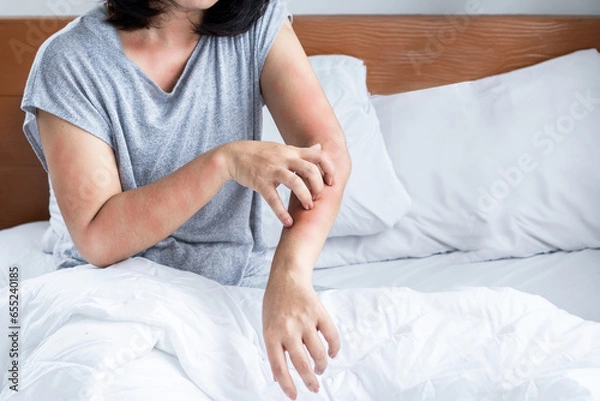 Obraz woman have problem with dust mites allergy bedding hand scratching her itchy and rash skin