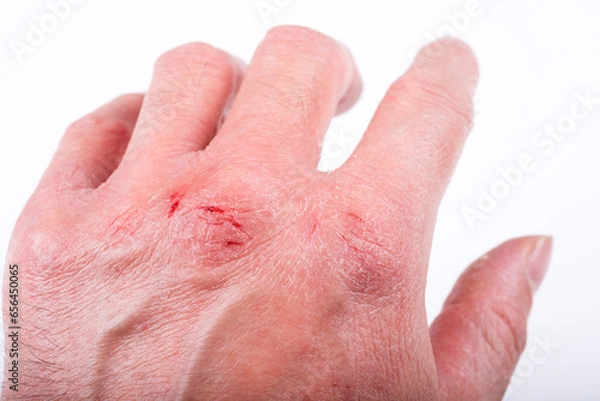 Obraz あかぎれの手の甲