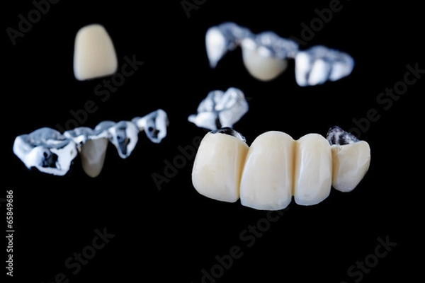 Obraz Proteza mostowa