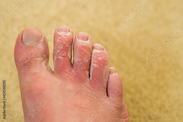 Fototapeta Close-up of the foot with fungal disease, deep scabbing on the toes,