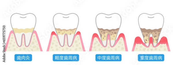 Obraz 歯周病の進行　症状