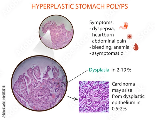 Fototapeta Infographic of the hyperplastic stomach polyps