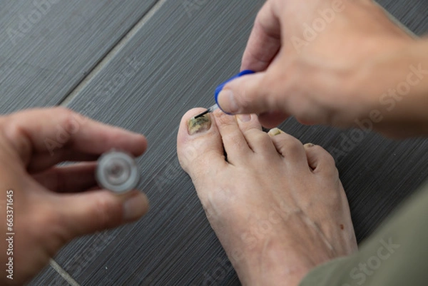 Obraz Man applies liquid to fungal nails with a brush