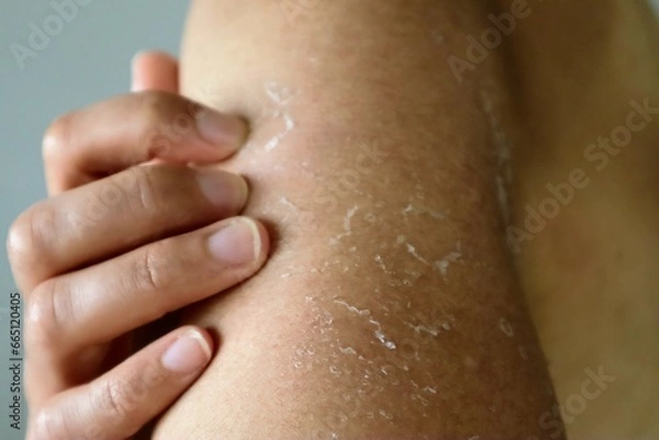 Obraz 日焼けして皮が剥けた肌